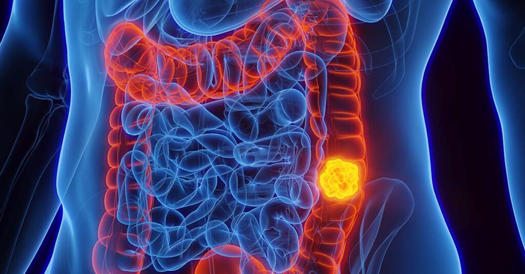 Sintomas e Riscos do Câncer Colorretal